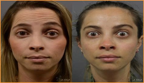 The American Idol Judge Before and After Botox, Facelift and Hair Transplant!